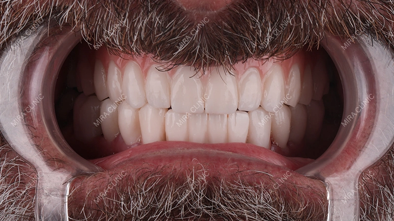 E-max Veneers Cost in Turkey